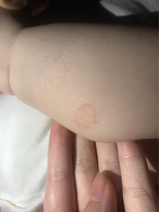 宝宝腿上湿疹
