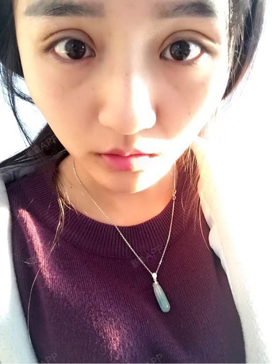 我在清木做的生态双眼皮第5天,8毫米的,我咋感觉这么宽啊,你们