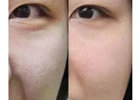 收缩毛孔案例_整容日记_整形前后对比照_【经典整形网】