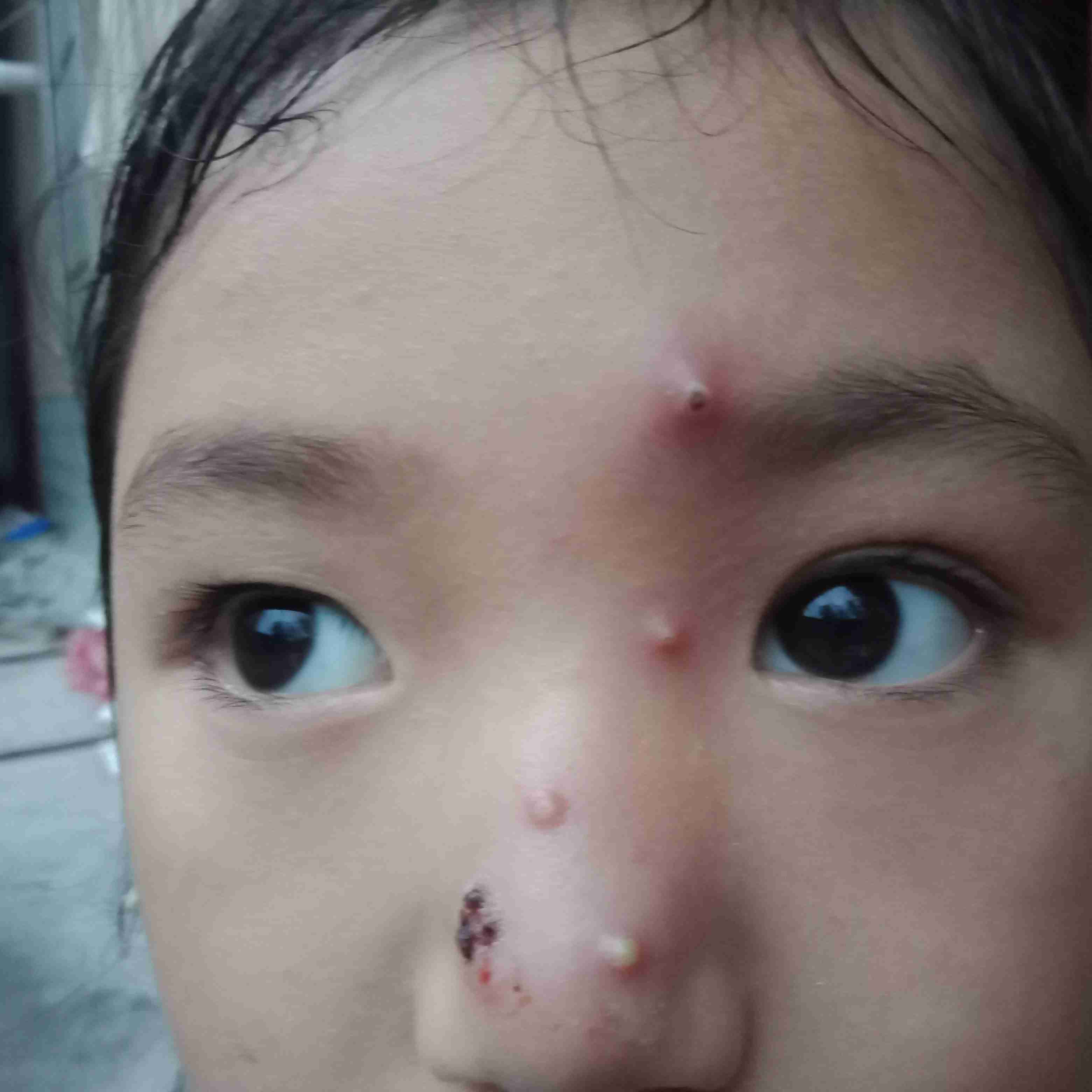 5岁小孩脸上长小红疙瘩