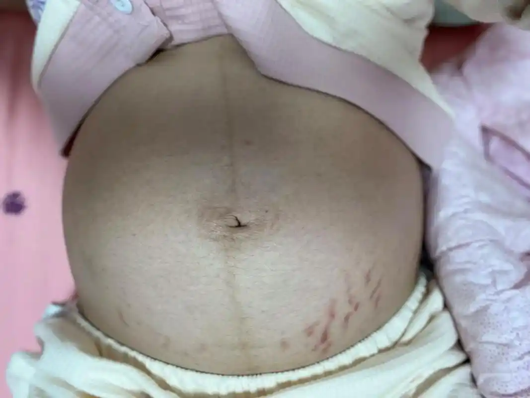 妊娠纹真的是一夜之间长的吗?我以为我是天选之子,七个多月都 - 抖音