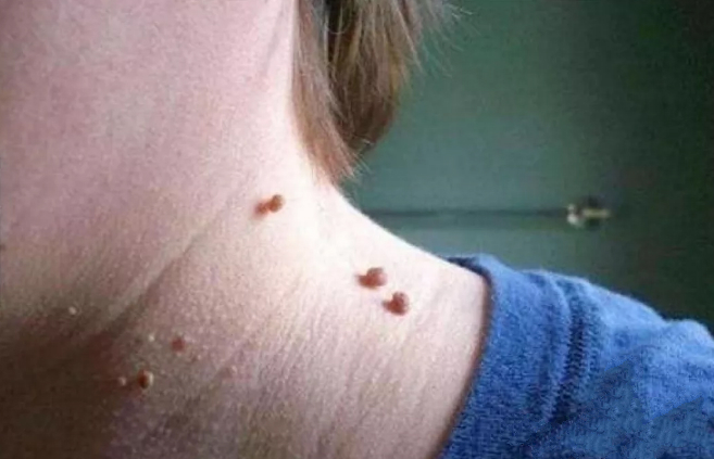 脖子上的丝状疣传染的越来越多别害怕丝瓜叶盐一抹就掉了