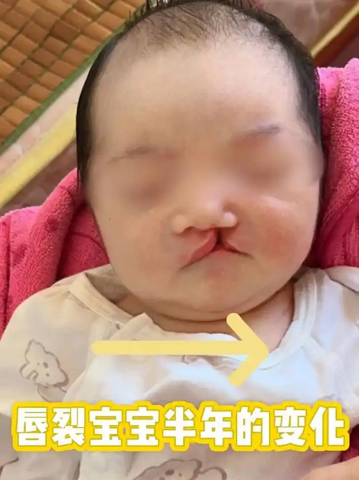 滣裂宝宝半年后的变化