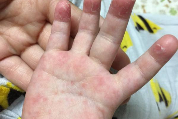 小孩子手上有红点图片_有来医生