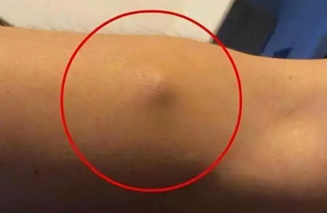 身上长"脂肪瘤"究竟要不要切除?不妨听听医生的说法,涨知识了