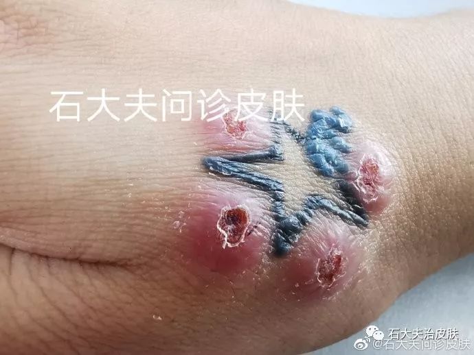 纹身后的你还好吗?——纹身必看!皮肤不良反应需知道
