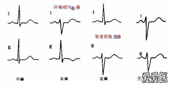 看图学心电02心电轴测量