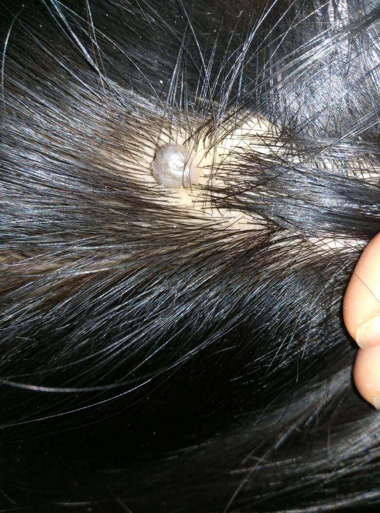 本人20,大概十年前后脑勺就长了这个东西,平时不