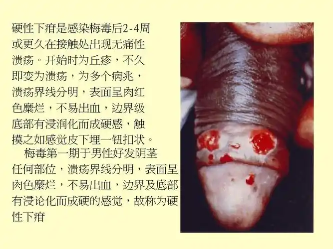 硬性下疳是感染梅毒后2-4周 或更久在接触处出现无痛性 溃疡.