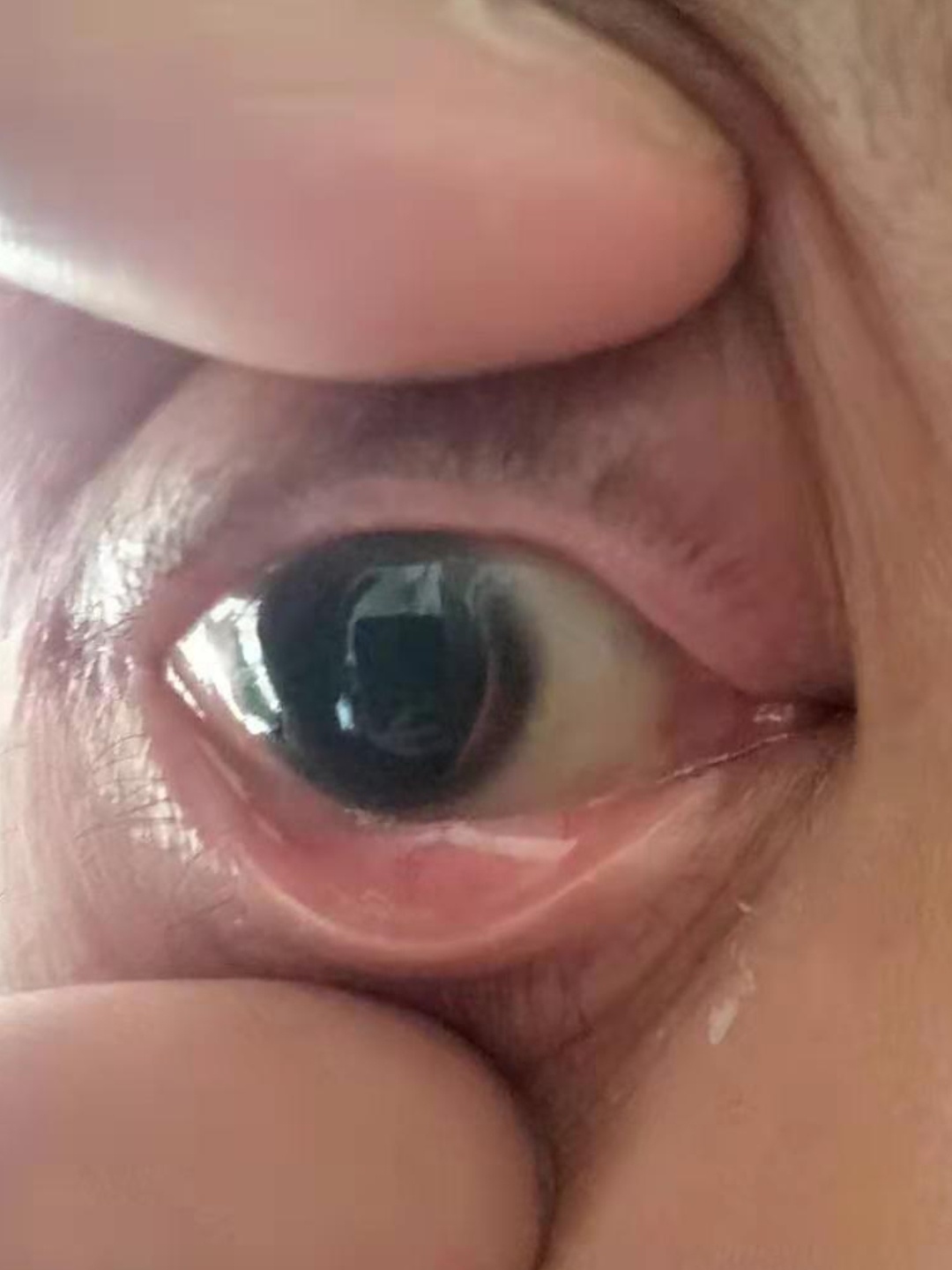 瞳孔散大的患者医院扩瞳要万分小心 前天,见了一位病人.