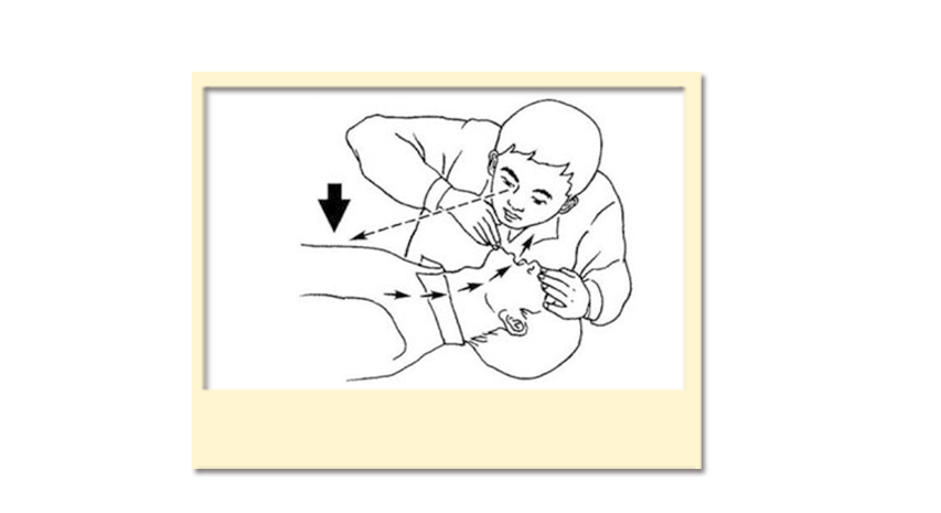 如何进行人工呼吸