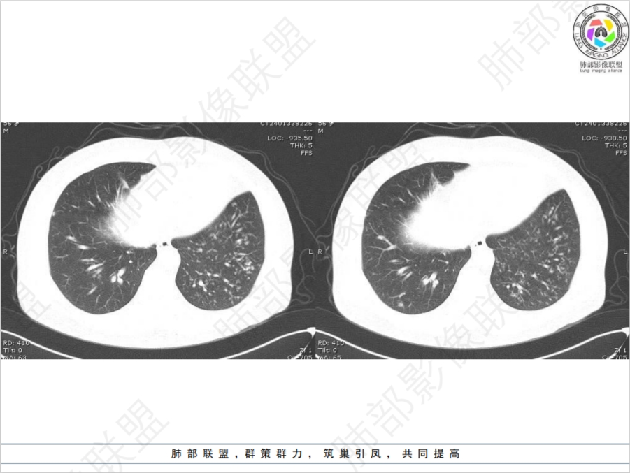 病灶多灶性,多态性,这个病例如何确诊肺结核?