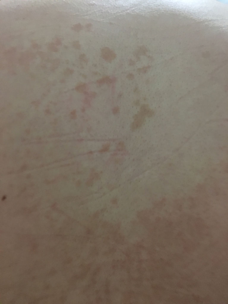 会不会扩散?求医生告知,在线等,急