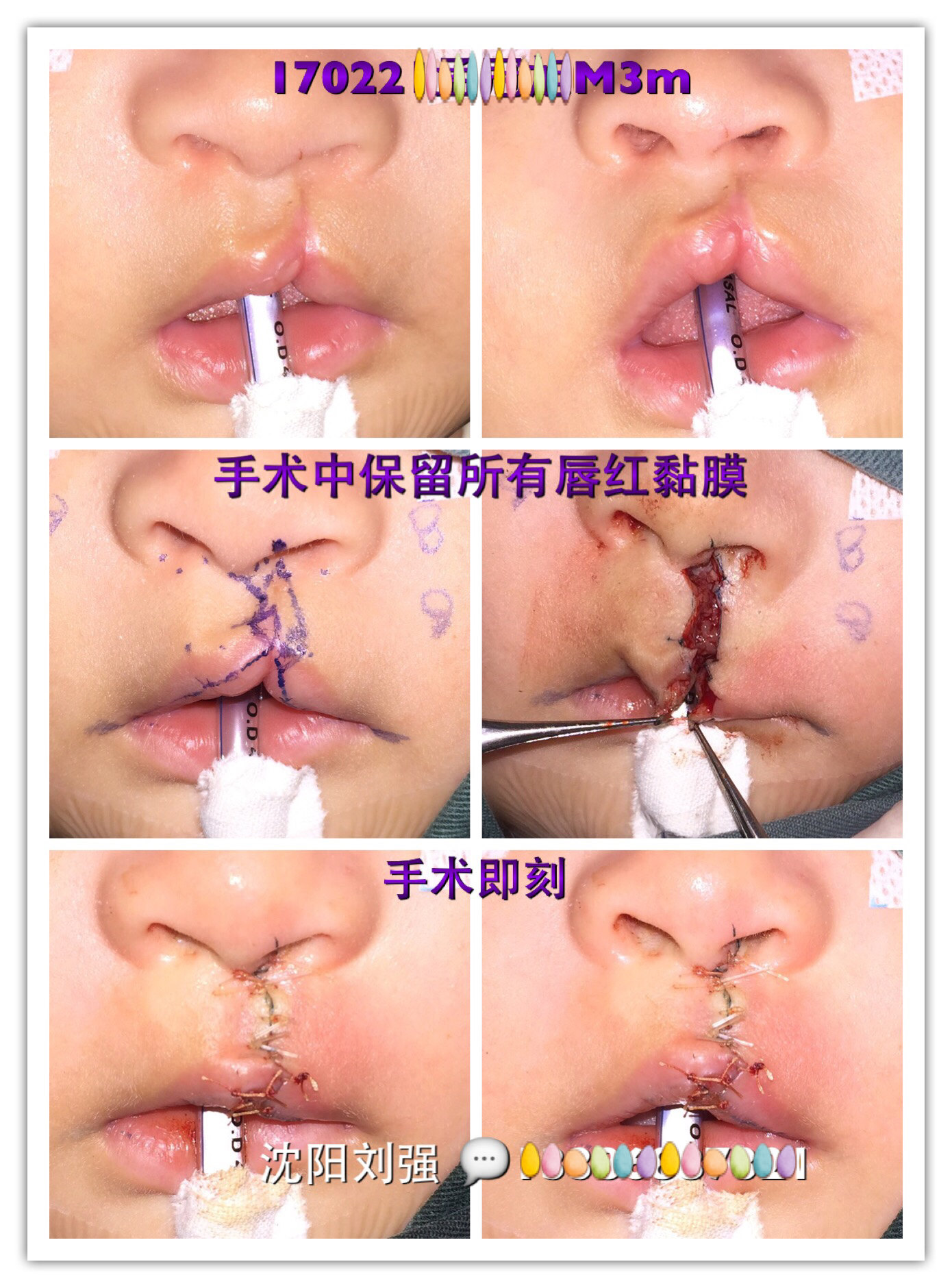 唇裂为什么需要二期修复 - 好大夫在线