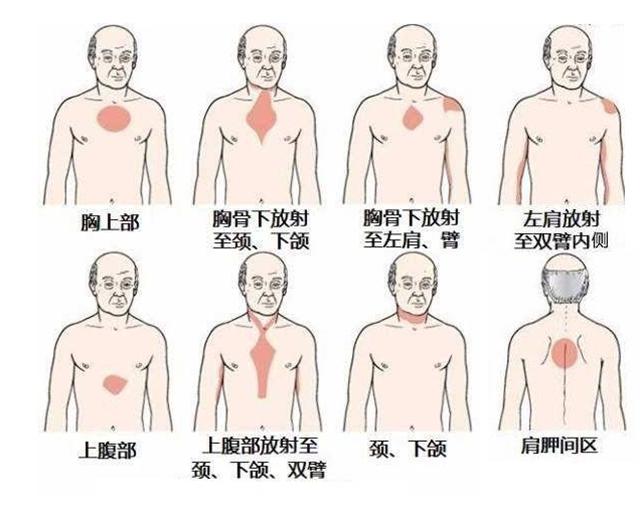 心绞痛发生的部位