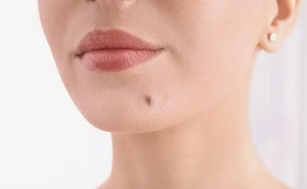 "古人说痣"顺口溜:长痣有说法,8大"富贵痣",看看你有吗?