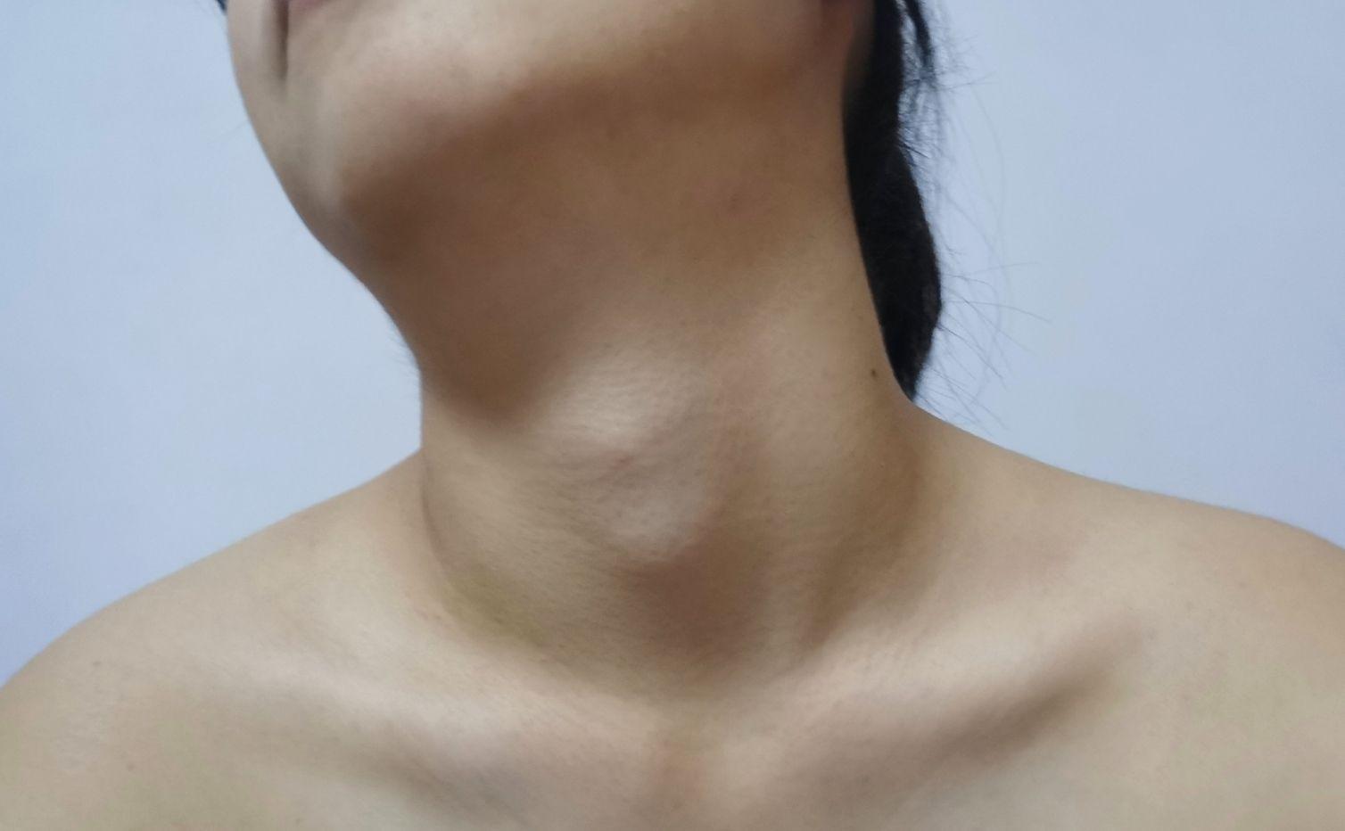 女生长喉结怎么办?是因为太瘦了还是激素分泌不正常? - 知乎