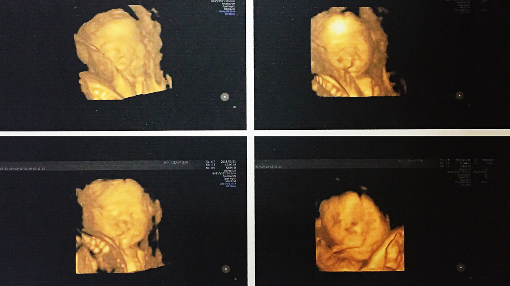 双胎宝妈21周做四维彩超,筛查出一名胎儿为"唇腭裂"