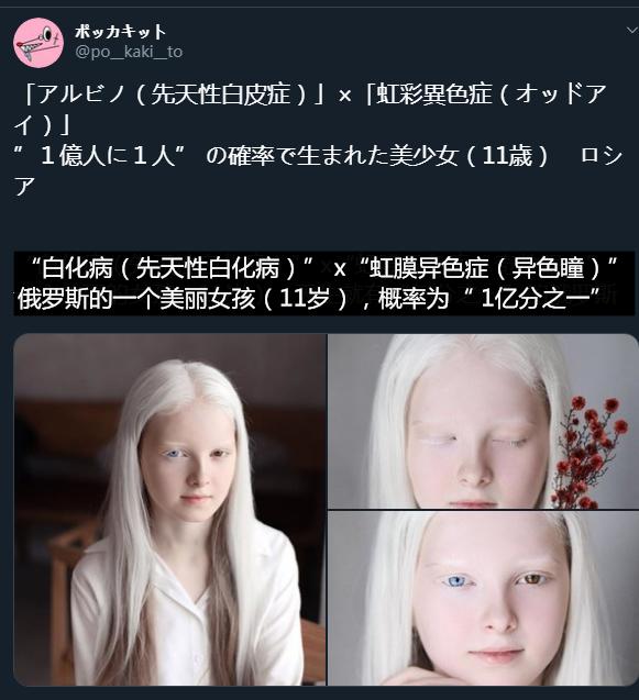 11岁美丽女孩天生白化病和异色瞳,美得像精灵,仿佛来自二次元!