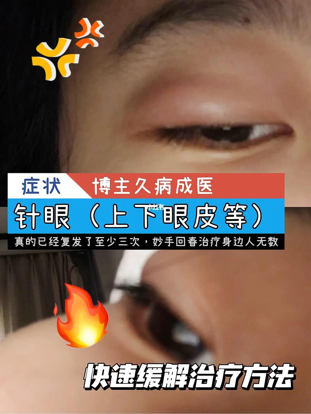 97针眼经历:16615第一次是在2020年冬,98眼睛不舒服,立马去了