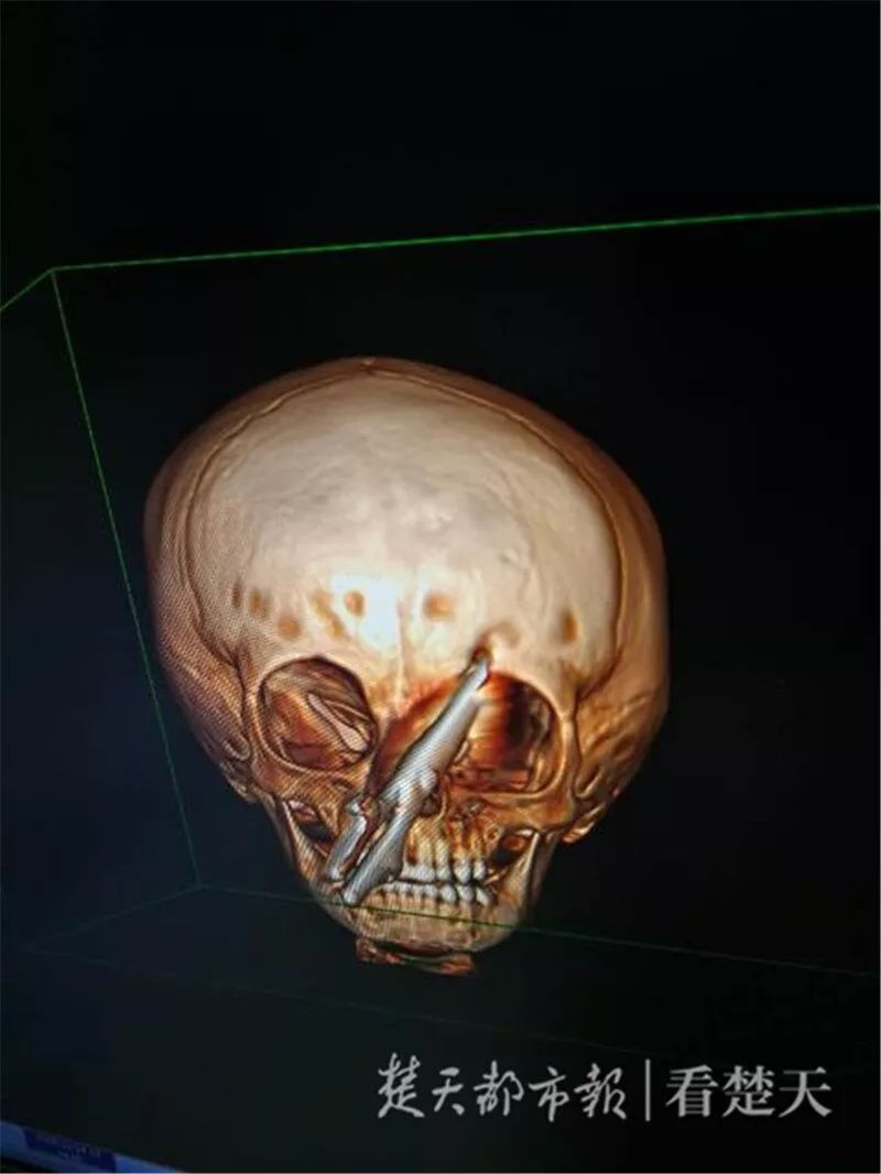 剪刀突然插进2岁男孩头颅!当时妈妈正在…医生也惊呆了