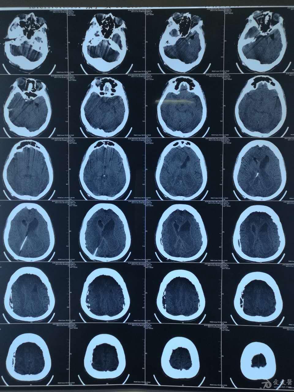 罕见脑积水病例
