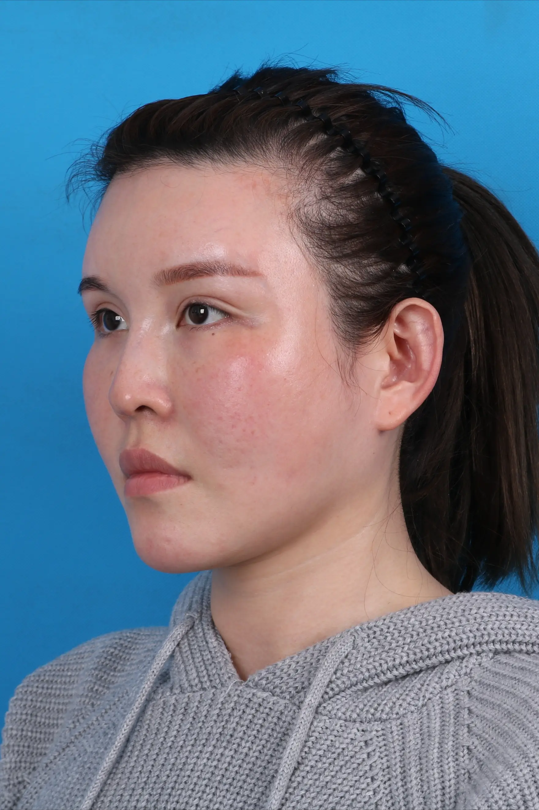 一名不喜欢"鼻梁塌"的30岁女孩来到北京整容,一个月后,结果揭晓_鼻子