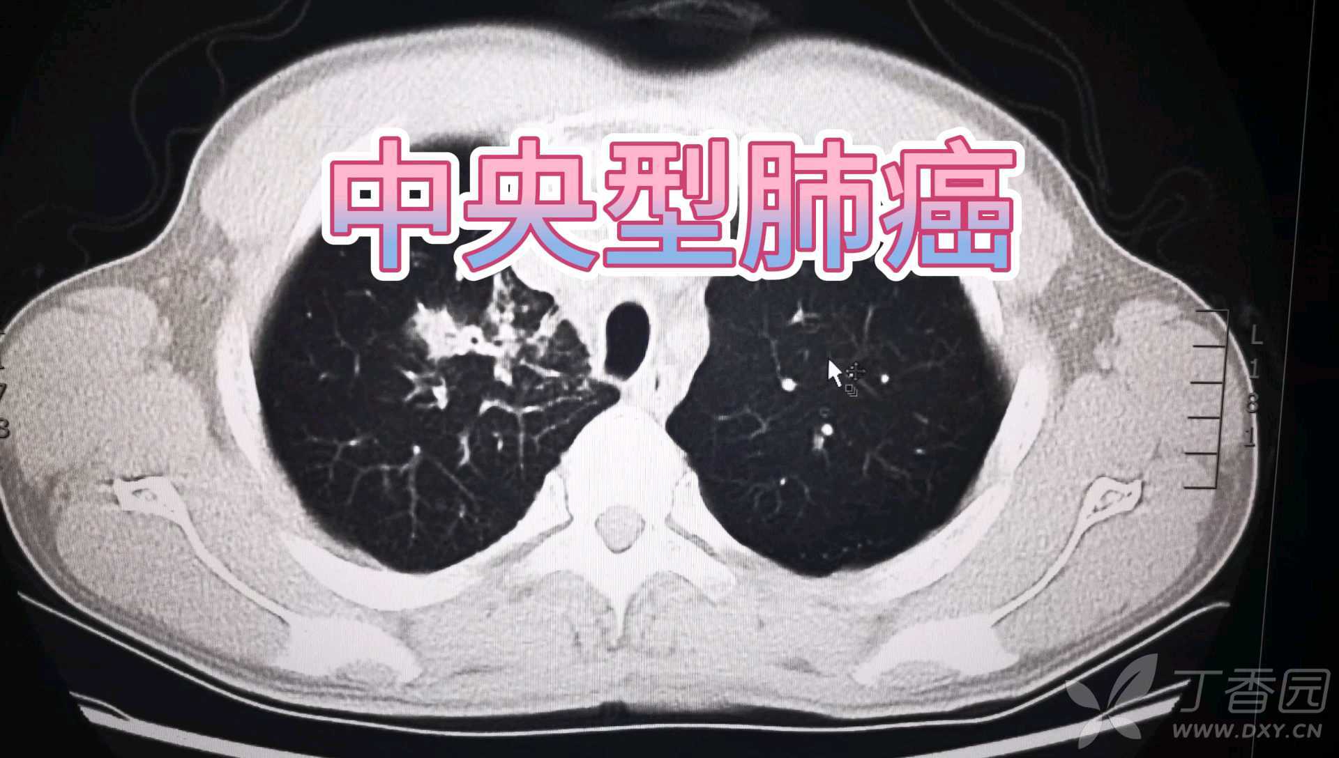 中央型肺癌一例直接征象和间接征象都有哪些