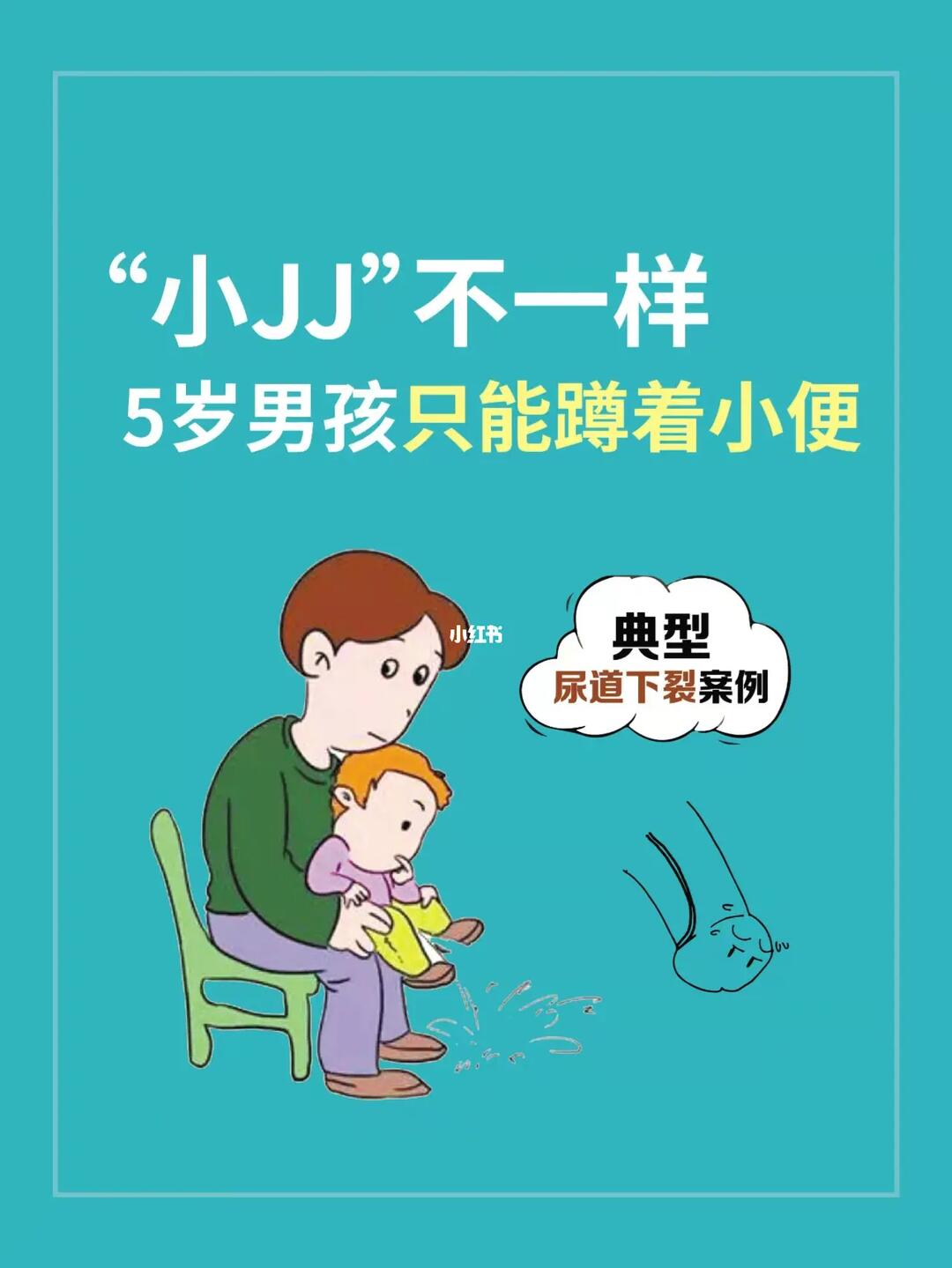 "小jj"不一样, 5岁男孩只能蹲着小便77_泌尿_幼儿园_尿道下裂手术