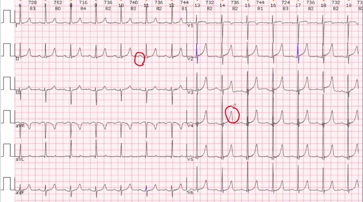 心电图不会看靠这5步就够了