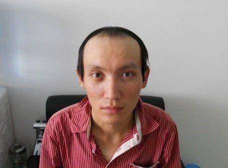 年纪轻轻就大量脱发出油,20出头的小伙子看着却像50岁的老大叔!