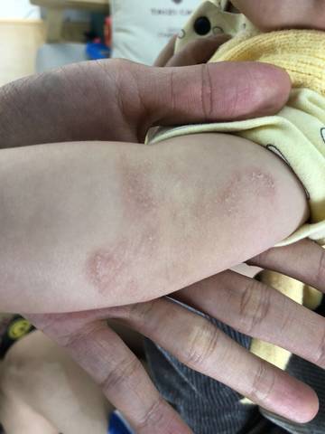 宝宝的手肘处长这种是什么啊,摸着很粗糙