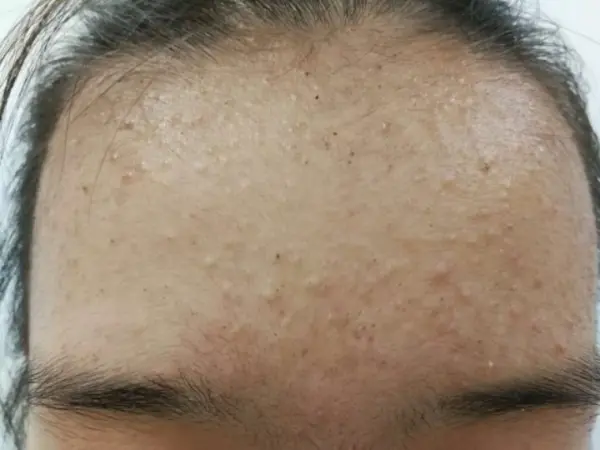 闭口粉刺该怎么祛除