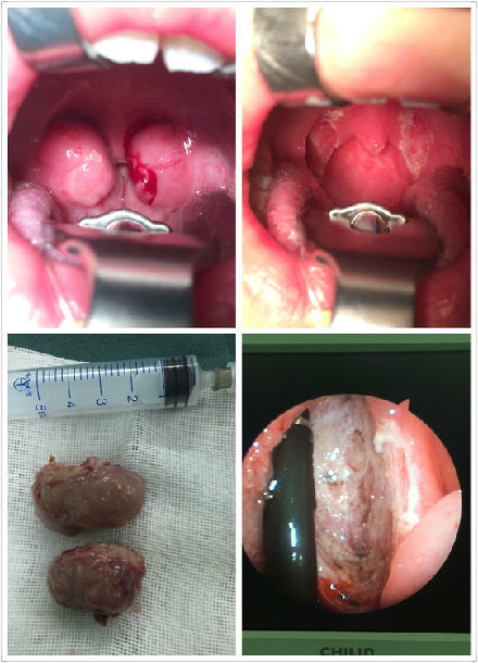 扁桃体手术前后图片.jpg