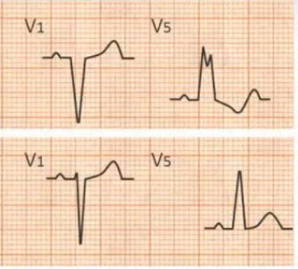 完全性左束支传导阻滞心电图特征有哪些?