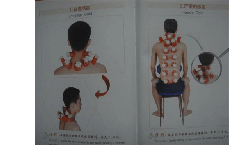 拔罐图解-一看就会(感冒 胆囊炎 便秘 头痛 肩周炎 腰捶间
