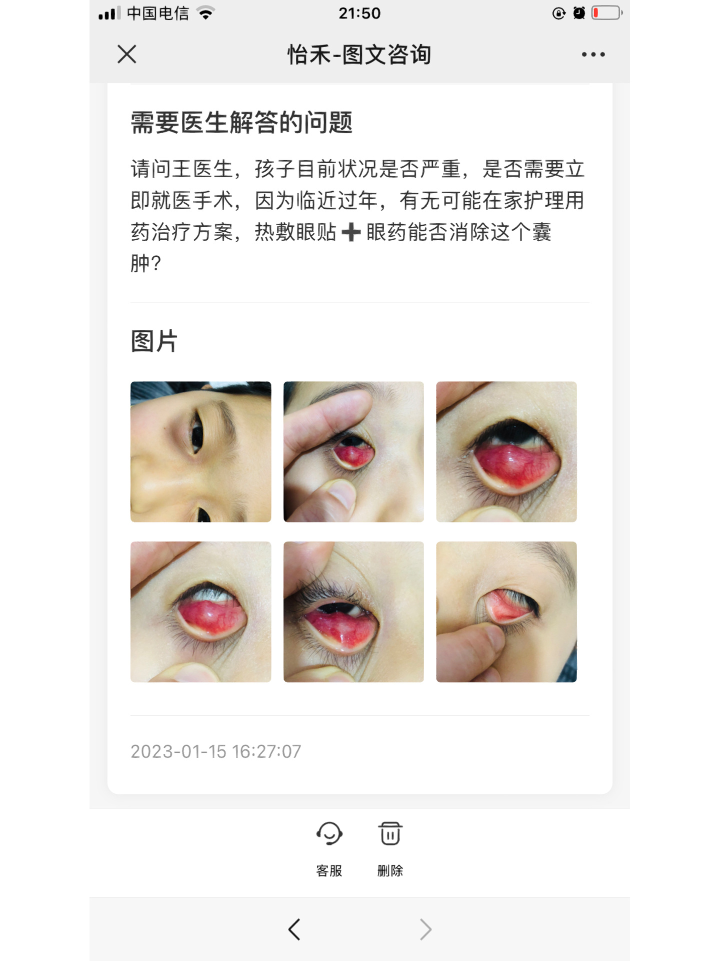 超大睑板腺囊肿(不用药就能消)  睑板腺囊肿,据说多发于青少年儿童
