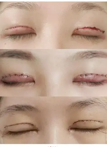 全切8mm双眼皮恢复图