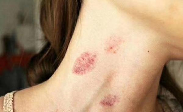 运动自习室情侣接吻种草莓印可能会致命