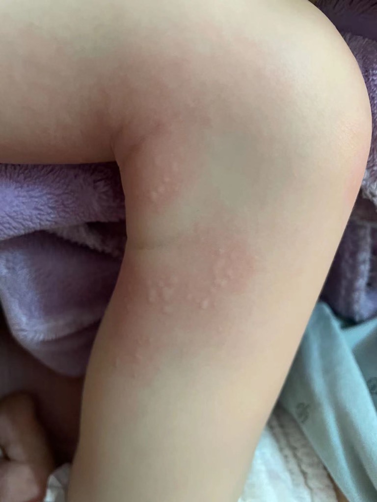 3岁男宝宝,症状如下,宝宝痒,有知道的宝妈吗?