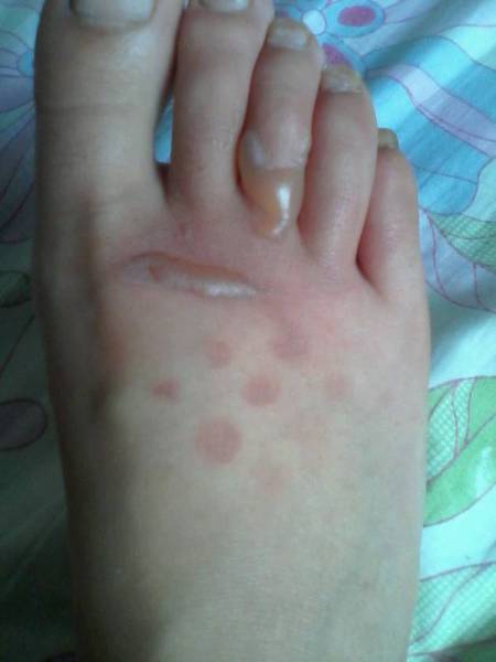 前天被开水把脚烫了,刚开始没起泡,我一直摸着依诺沙星乳膏,可这两天