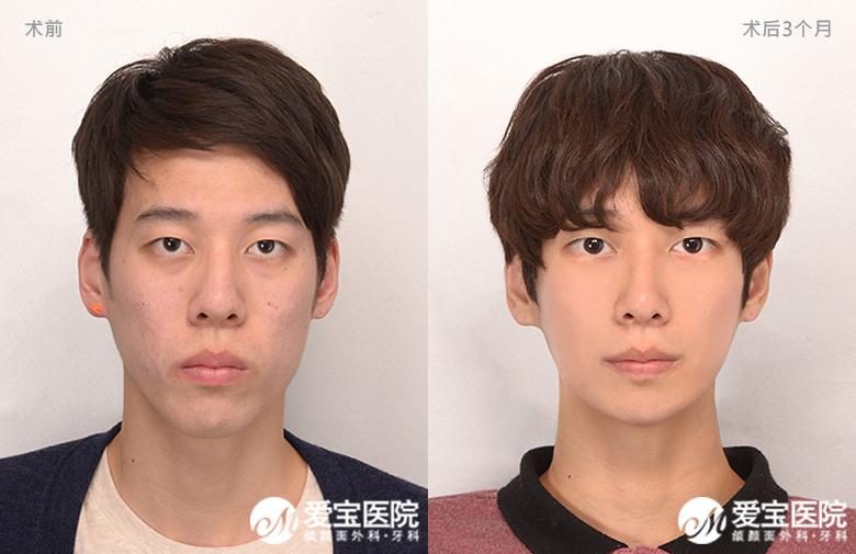 韩国做轮廓好的医院中爱宝属于什么水准