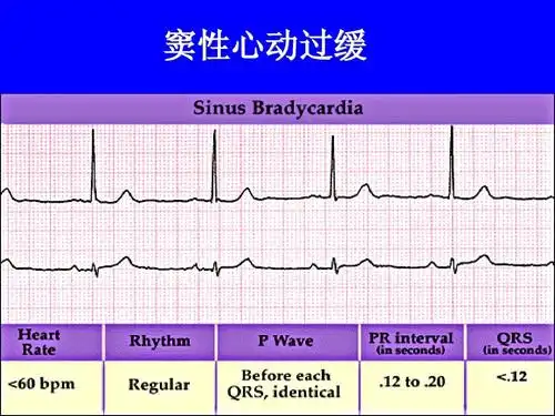 窦性心律过缓能参加了保险