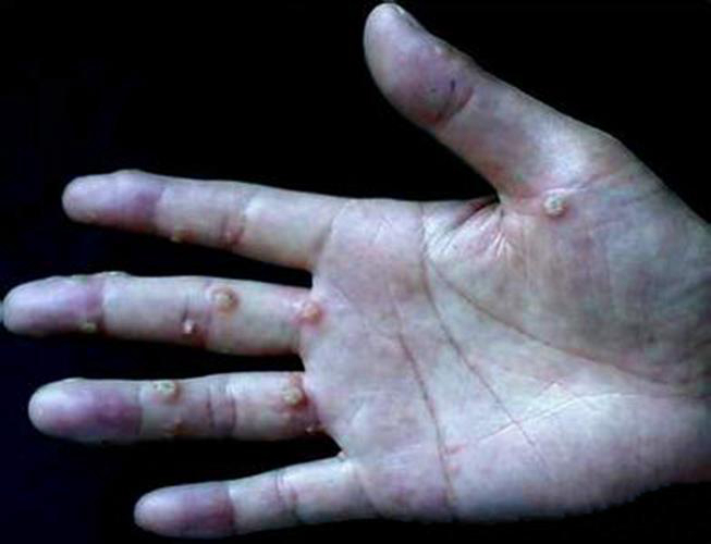 手掌上的扁平疣图片