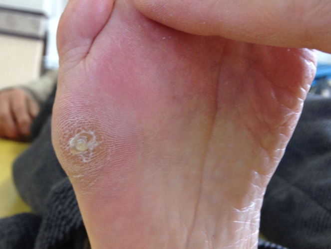 北京胼胝专家_北京治疗胼胝哪个专家好_北京治疗胼胝最