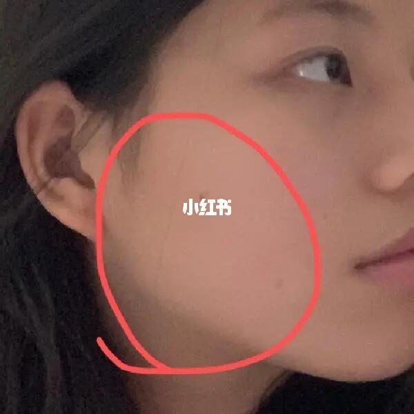 怎么能够改善侧脸宽大