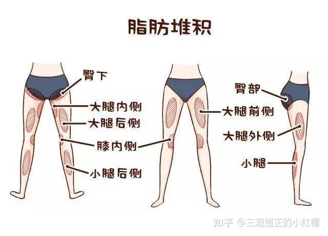 广州吸脂|大腿吸脂的重点在哪?是细吗?不!是这两样!