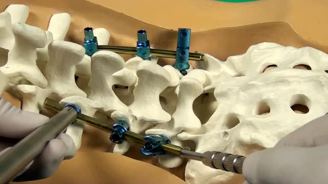 脊柱产品线-titan钉棒系统操作