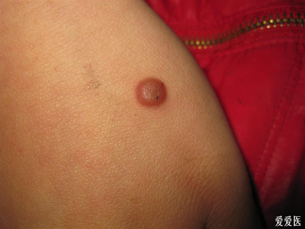 看图识病传染性软疣