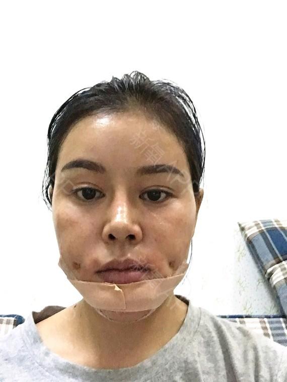 【整容案例】酒窝成形术(人造酒窝)|原来有了酒窝可以笑得这么没